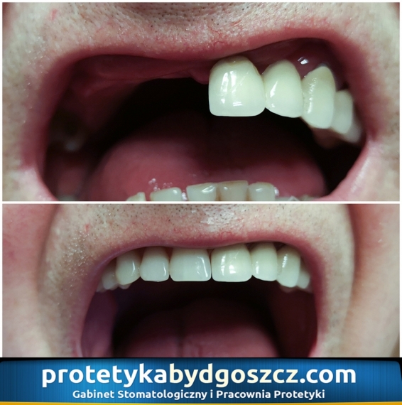 Przed i po uzupełnieniu braków zębowych