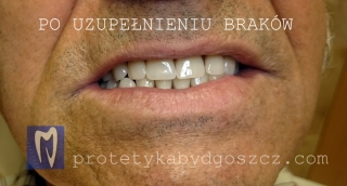 Pacjent po uzupełnieniu braków zębowych w szczęce i żuchwie.
